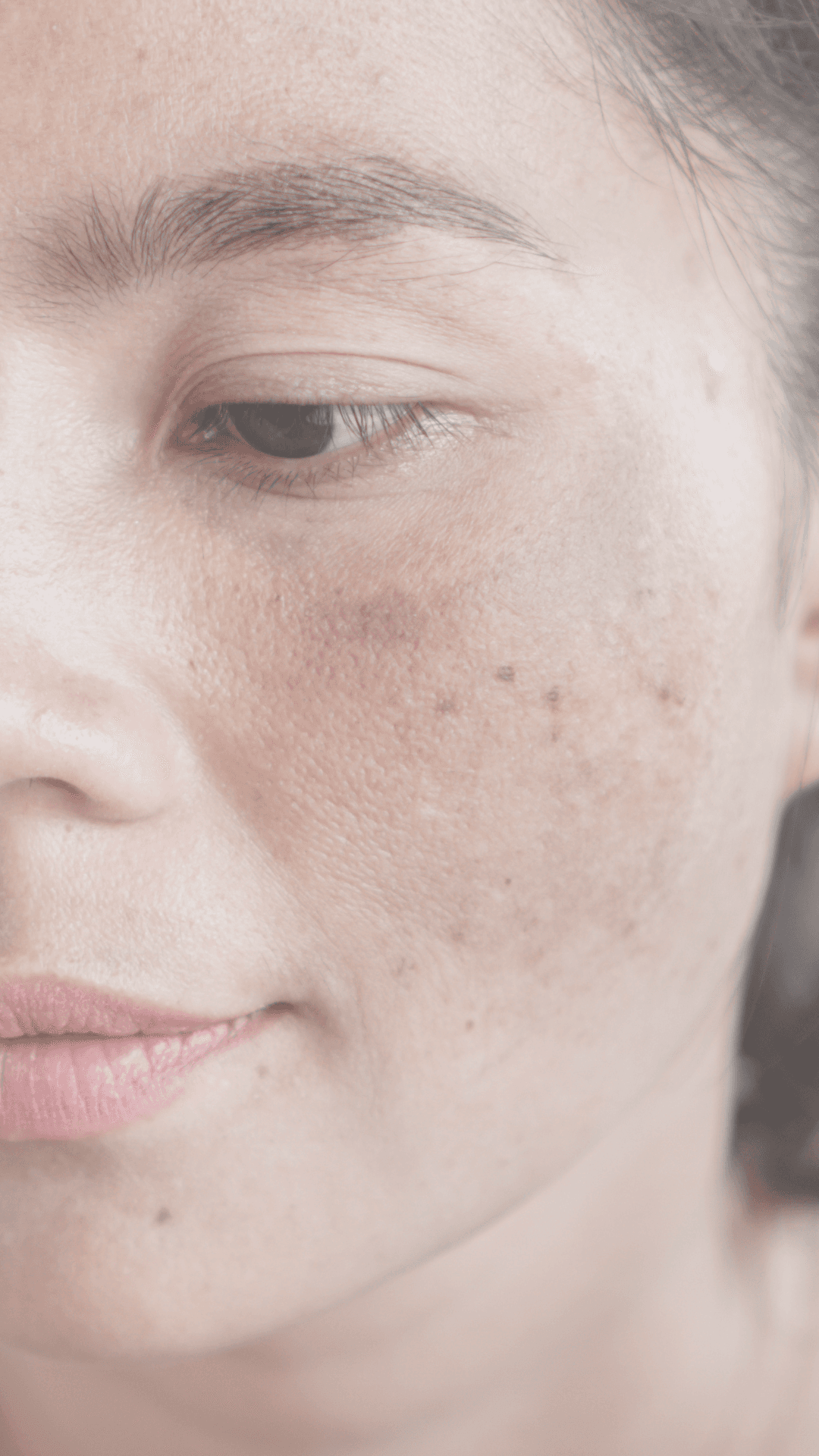 Melasma