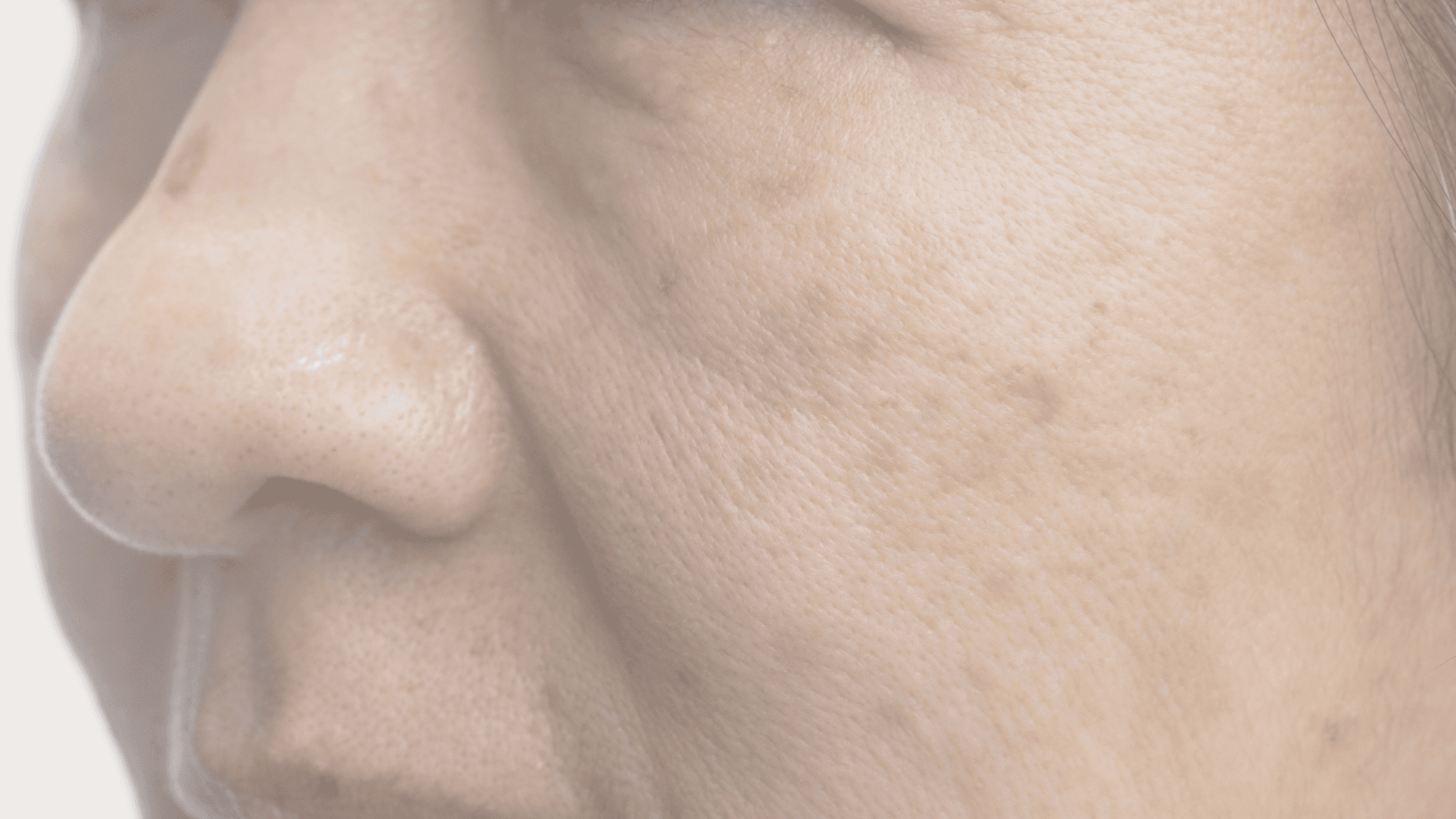 Melasma